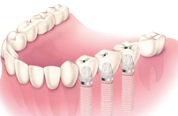 インプラント治療
