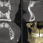 歯内療法の「三種の神器」について